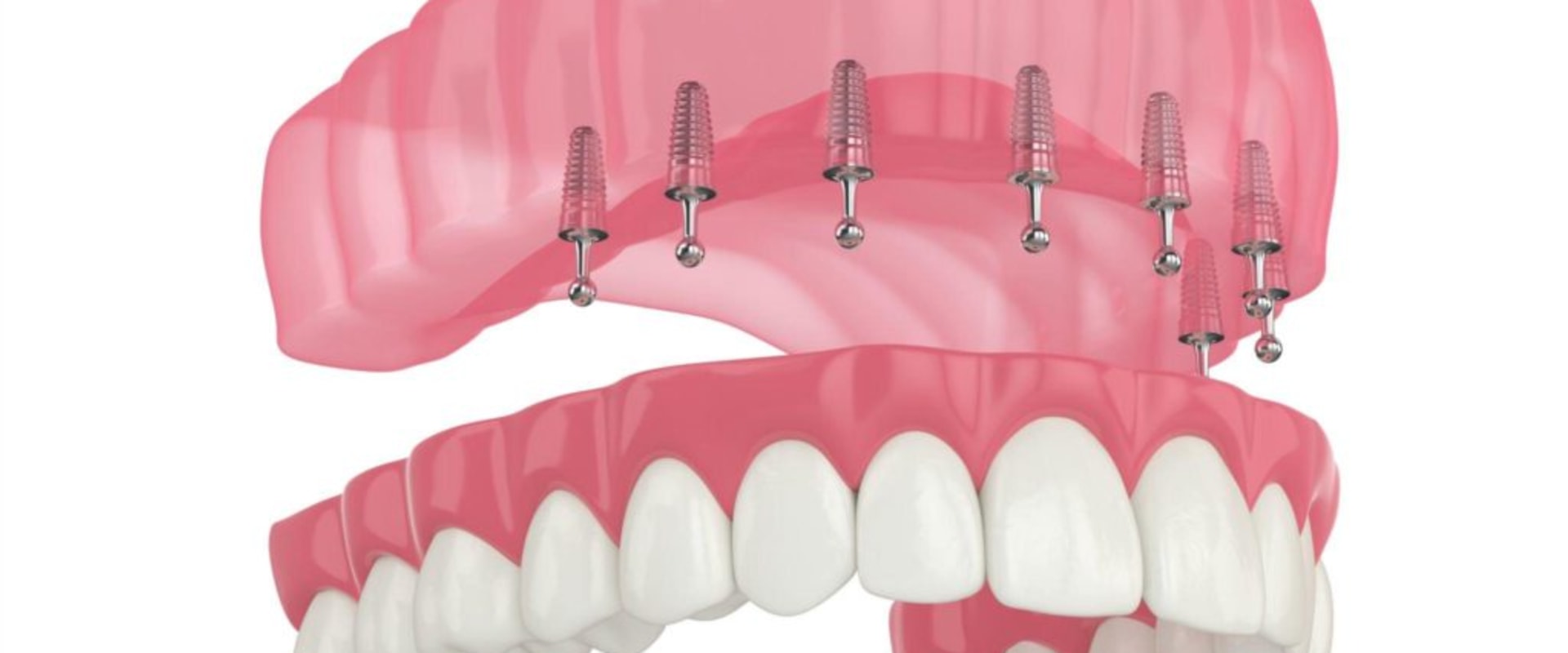 Understanding Snap-On Dentures: A Comprehensive Guide