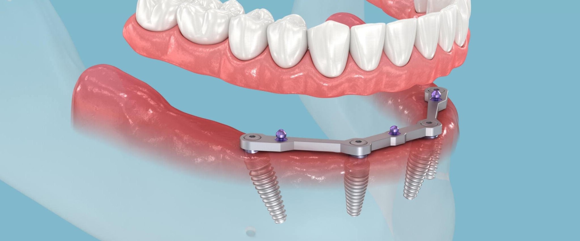 Understanding the All-on-4 Procedure: A Comprehensive Guide to Replacing Missing Teeth