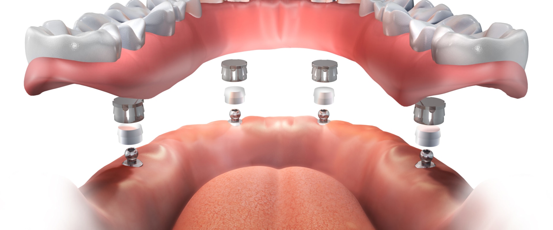 All-on-4 vs. Traditional Dentures: What You Need to Know