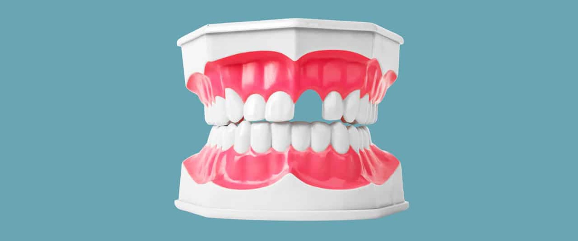 The Importance of Complete Dentures for Replacing Missing Teeth