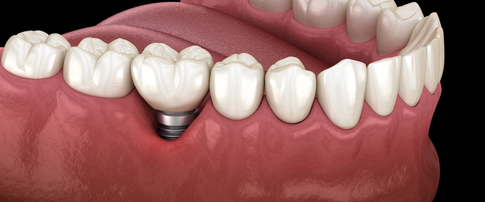 A Comprehensive Look at Who is a Good Candidate for Dental Implants