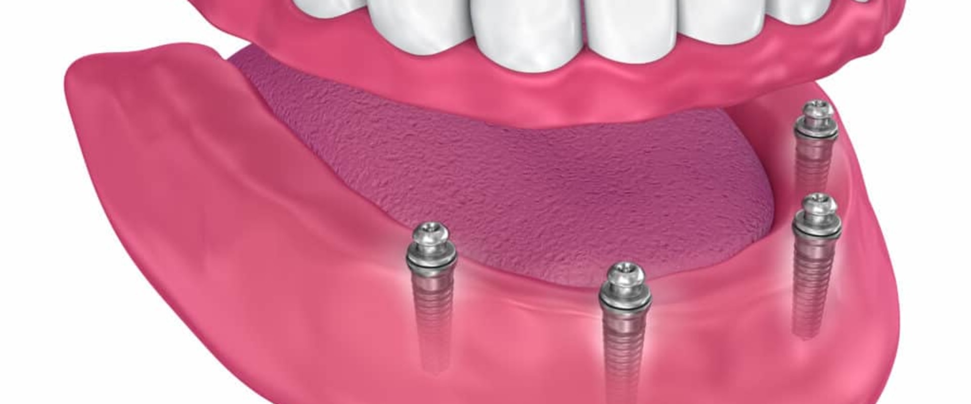 Maintenance Requirements for Implants vs. Dentures: A Complete Guide