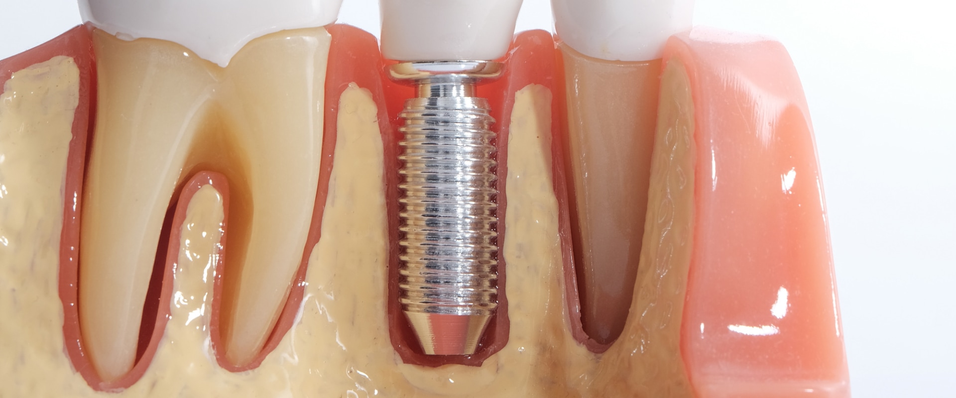 Factors that may affect the success of implants or dentures