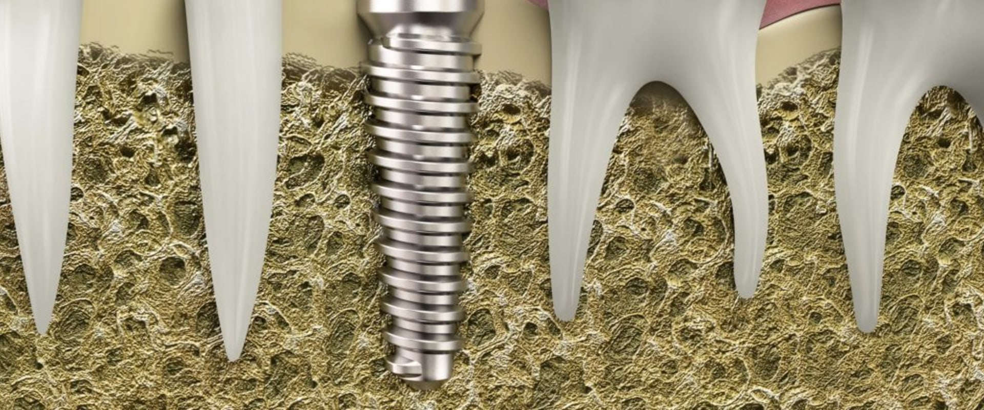 Understanding the Potential Complications and Risks of Dentures and Dental Implants