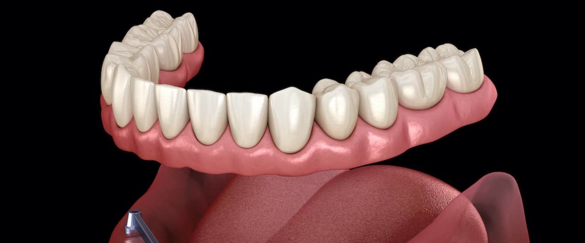 Exploring the Cost and Maintenance of Implant-Supported Dentures