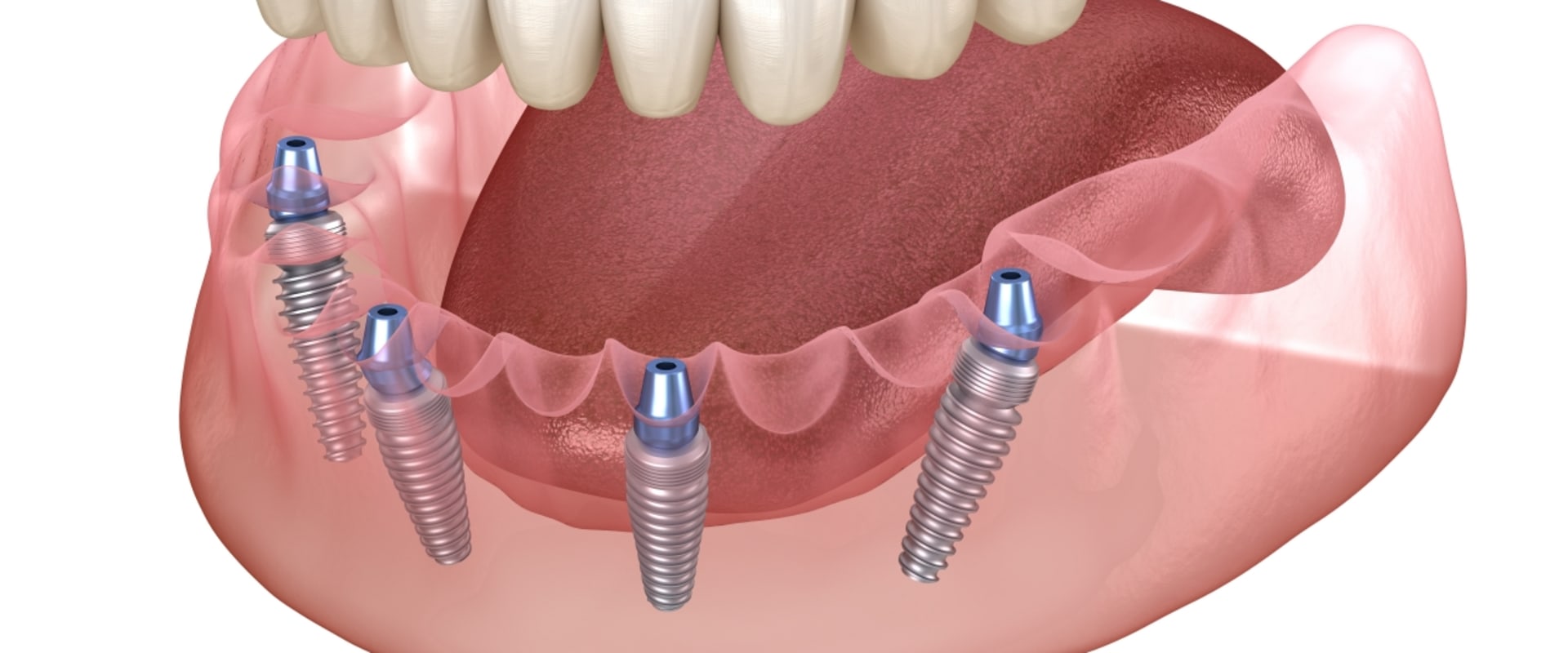 All You Need to Know About Implant-Supported Dentures