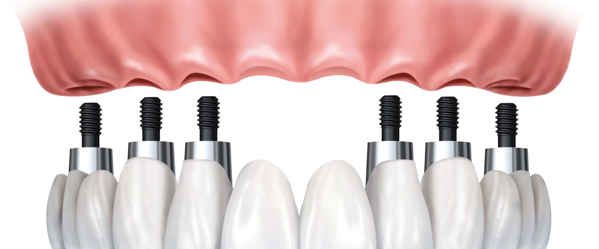 Comparing Implant-Supported vs. Traditional Dentures: What You Need to Know