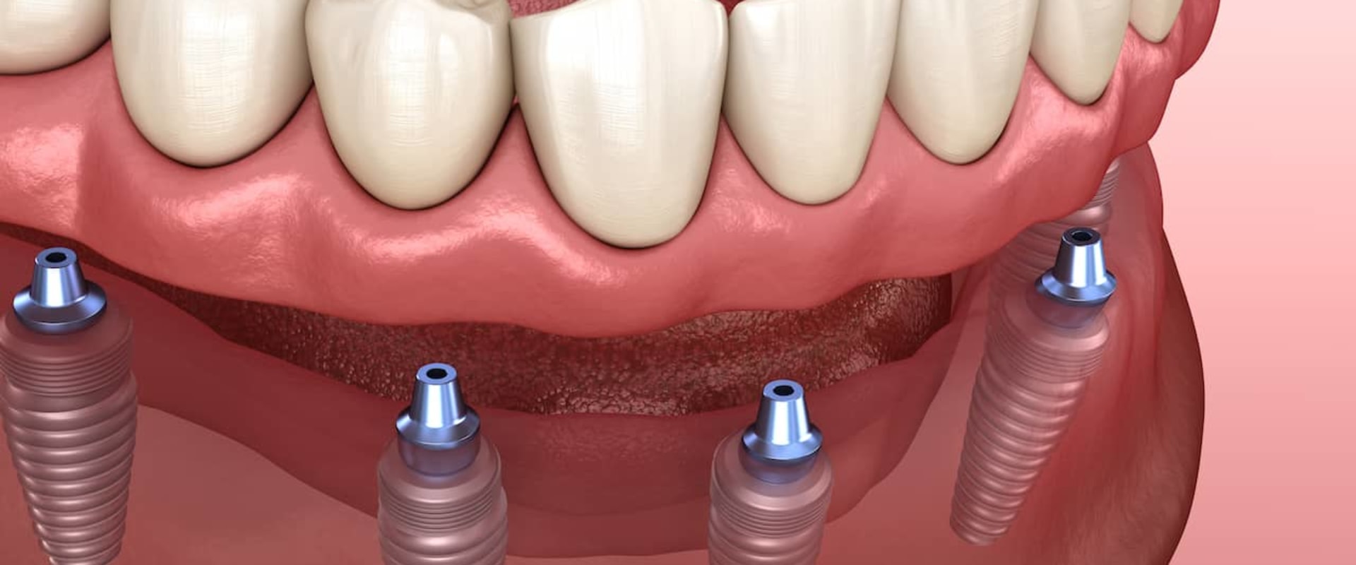 Understanding the Long-Term Costs of Implants and Dentures for Replacing Missing Teeth