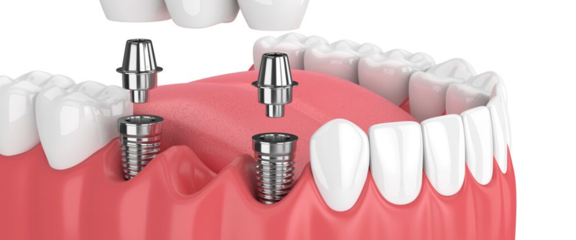 Understanding the Benefits of Dental Implants for Replacing Missing Teeth