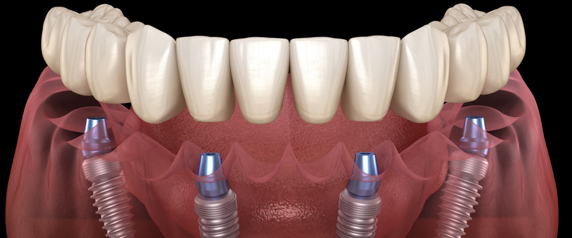 All About Long-Term Success Rates of All-on-4 Dentures