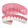 Understanding Snap-On Dentures: A Comprehensive Guide