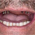 Dentures vs. Dental Implants: Which is Right for You?