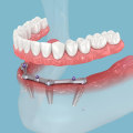 Understanding the All-on-4 Procedure: A Comprehensive Guide to Replacing Missing Teeth