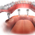 All-on-4 vs. Traditional Dentures: What You Need to Know