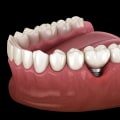 A Comprehensive Look at Who is a Good Candidate for Dental Implants