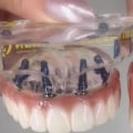 Alternative Solutions for Keeping Dentures in Place: A Complete Guide