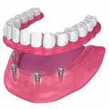 Maintenance Requirements for Implants vs. Dentures: A Complete Guide