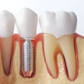 Factors that may affect the success of implants or dentures