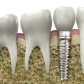 Understanding the Potential Complications and Risks of Dentures and Dental Implants