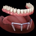 Exploring the Cost and Maintenance of Implant-Supported Dentures