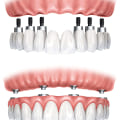 Comparing Implant-Supported vs. Traditional Dentures: What You Need to Know