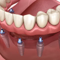 Understanding the Long-Term Costs of Implants and Dentures for Replacing Missing Teeth