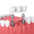 Understanding the Benefits of Dental Implants for Replacing Missing Teeth