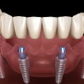 All About Long-Term Success Rates of All-on-4 Dentures