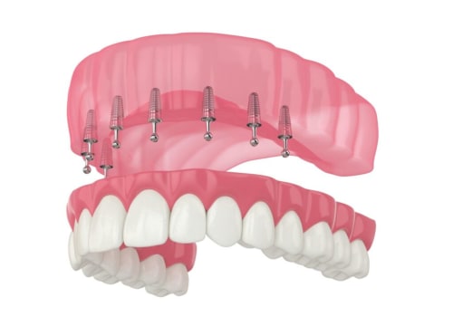 Understanding Snap-On Dentures: A Comprehensive Guide