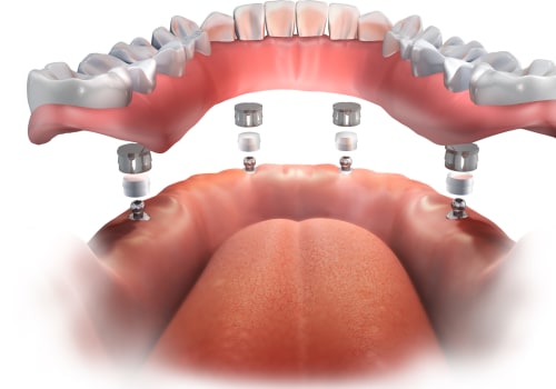 All-on-4 vs. Traditional Dentures: What You Need to Know