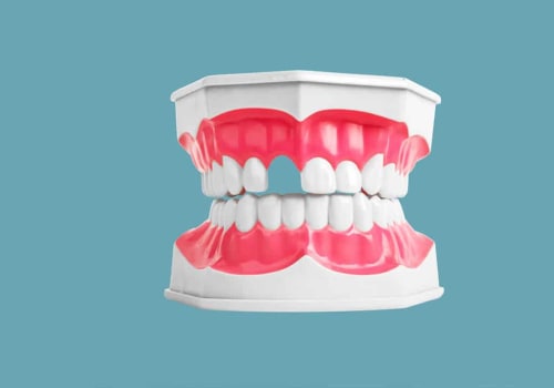 The Importance of Complete Dentures for Replacing Missing Teeth