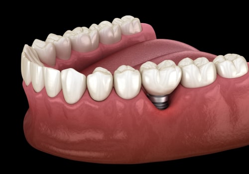 A Comprehensive Look at Who is a Good Candidate for Dental Implants