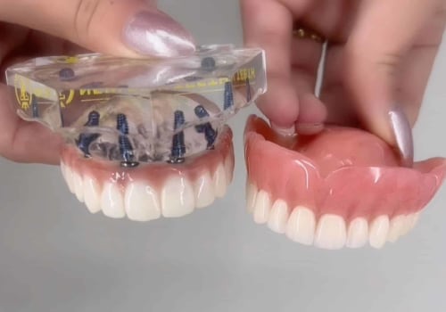 Alternative Solutions for Keeping Dentures in Place: A Complete Guide