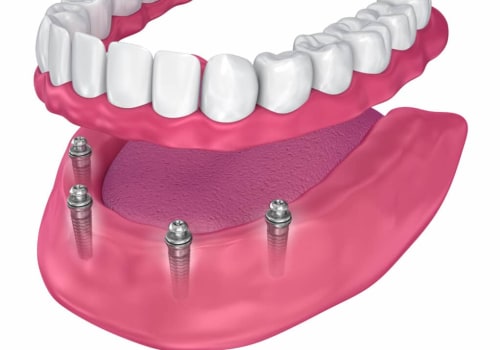 Maintenance Requirements for Implants vs. Dentures: A Complete Guide