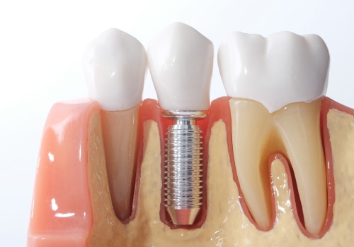 Factors that may affect the success of implants or dentures