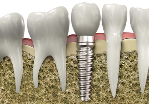 Understanding the Potential Complications and Risks of Dentures and Dental Implants