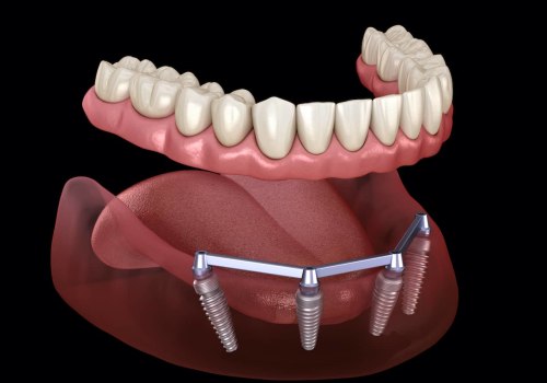 Exploring the Cost and Maintenance of Implant-Supported Dentures