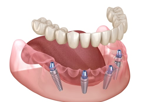 All You Need to Know About Implant-Supported Dentures