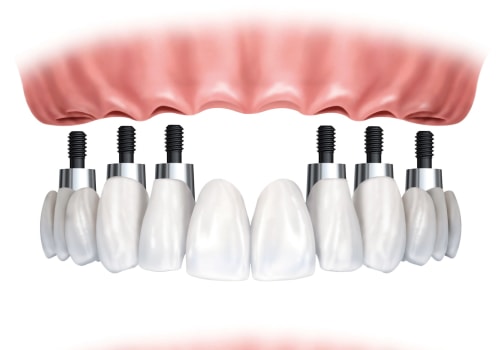 Comparing Implant-Supported vs. Traditional Dentures: What You Need to Know