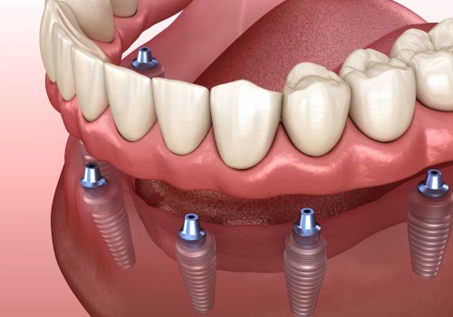 Understanding the Long-Term Costs of Implants and Dentures for Replacing Missing Teeth