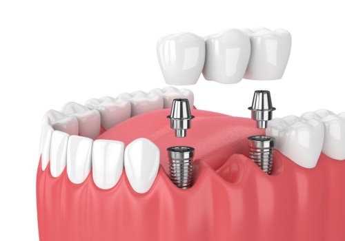 Understanding the Benefits of Dental Implants for Replacing Missing Teeth