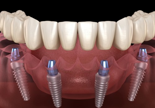 All About Long-Term Success Rates of All-on-4 Dentures